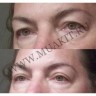 wm_double_eyelid_L07ay.jpg