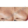 wm_blackhead_finger_03.jpg